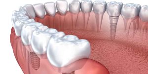 Learn How Dental Implants Could Help Your Dental Health